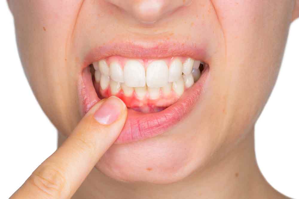 A patient at West Richland Family Dental shows enflamed gums, the beginnings of gum disease.