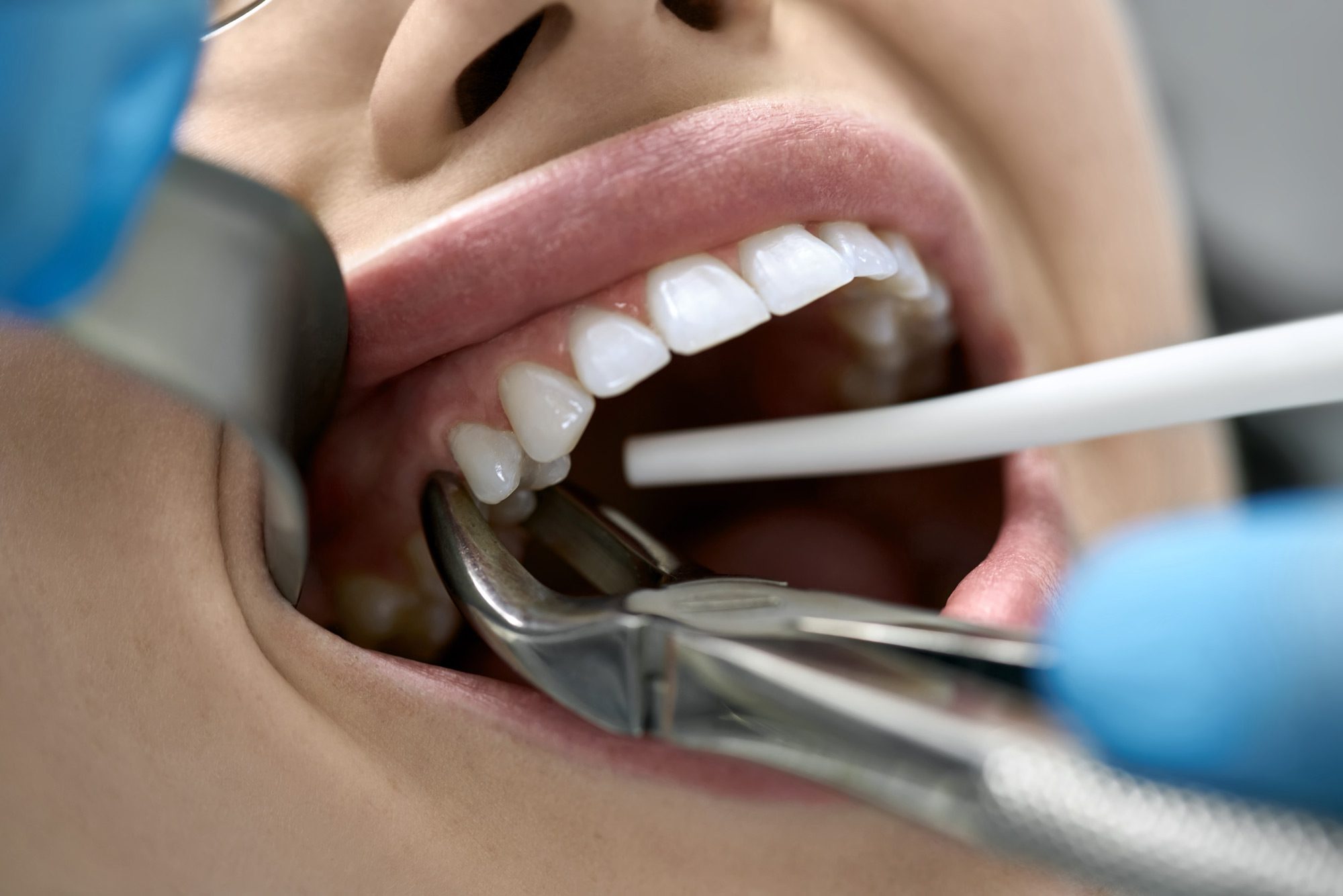 woman getting her tooth removed at West Richland Family Dental in Washington